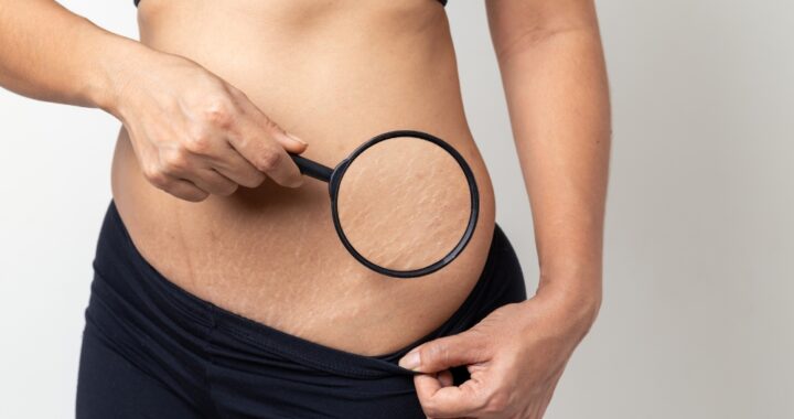 5 efikasnih načina da sprečite strije tokom trudnoće